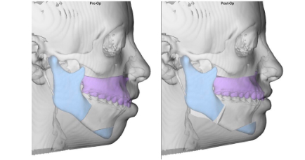 cirurgia-ortognatica-4.jpg