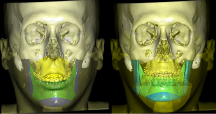 cirurgia-ortognatica-6.jpg