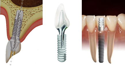 implantes-1.jpg